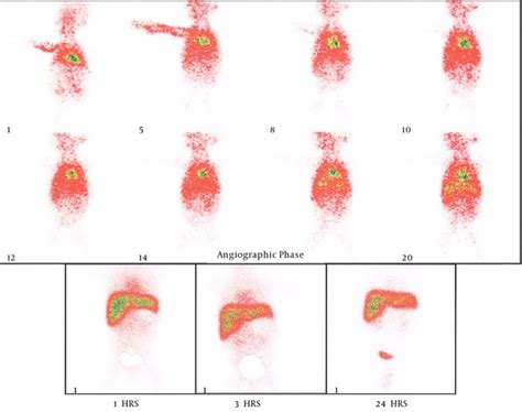 Image result for Hida Scan Explained