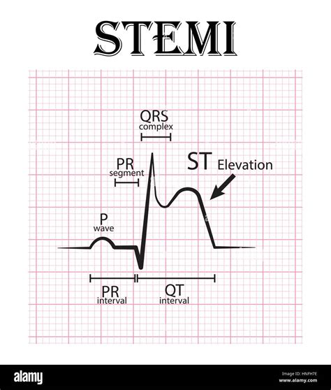 ECG of ST elevation myocardial infarction ( STEMI ) and detail of ECG ( P wave , PR segment , PR ...