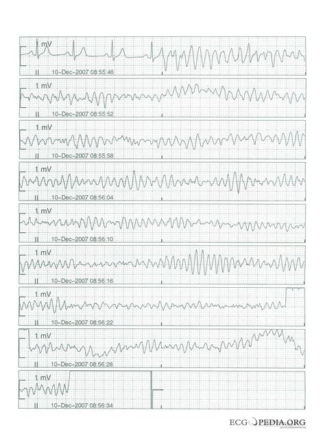 Torsades de pointes ekg examples - wikidoc