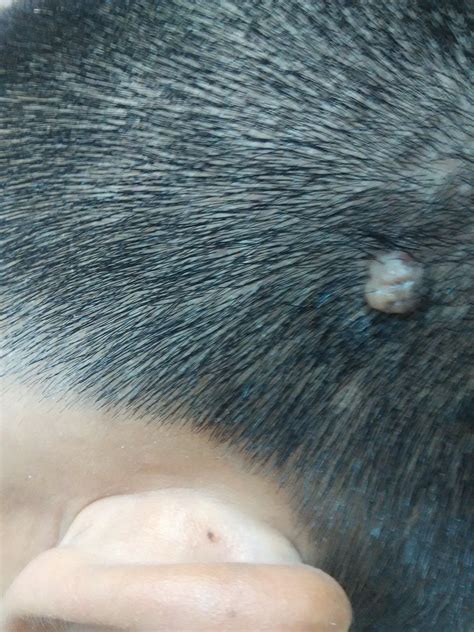 我的头皮上有个小的肉瘤，怎么办？灰色的，不碰它，会慢慢变小，但还是能看出来。_百度知道