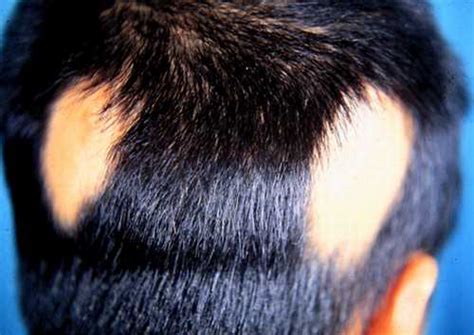 罗缔发域答疑为什么斑秃恢复期长出来头发是白色的？ - 知乎
