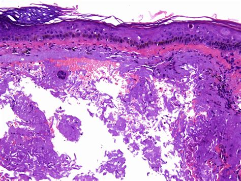 Actinic Keratosis Histology