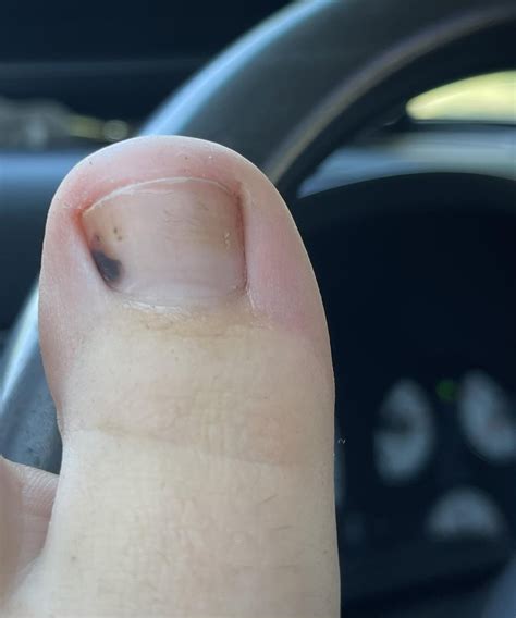 Black spot on big toe : r/DiagnoseMe