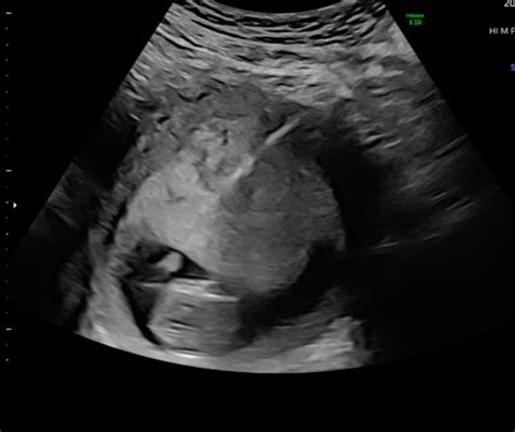 The Fetal Medicine Foundation India Trust – FMF UK Authorized Examining ...