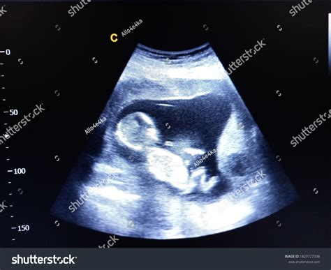 30 Ultrasound 14 weeks pregnant Images, Stock Photos & Vectors ...