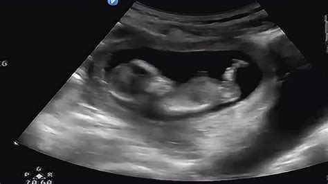 怀孕13周的B超图。大家看一下，胎儿正常吗？_百度宝宝知道-34周胎儿B超单，谁给看一下。谢谢！