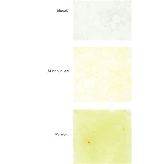 Sputum chart. Sputum is graded as mucoid, mucopurulent or purulent ...