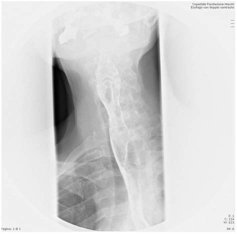 Dental Prosthesis in Esophagus: A Right Cervicotomic Approach