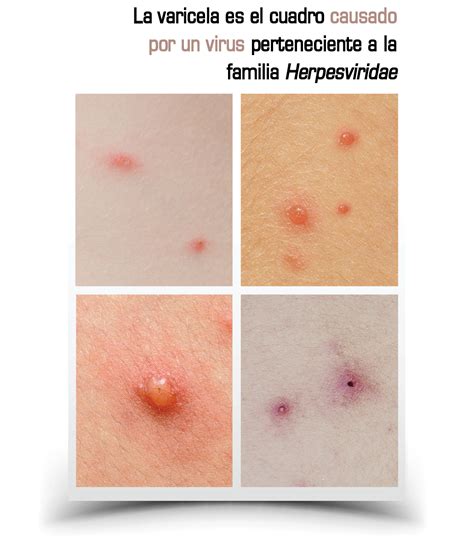 Varicela Fases Y Causas _ Varicela: causas, síntomas y tratamiento – DIMSO