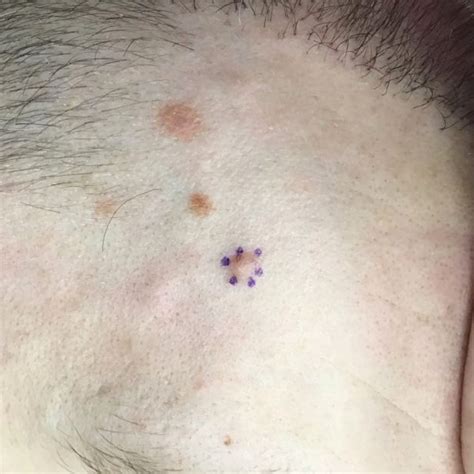 Intradermal Nevus | Causes, Diagnosis & Safe Removal