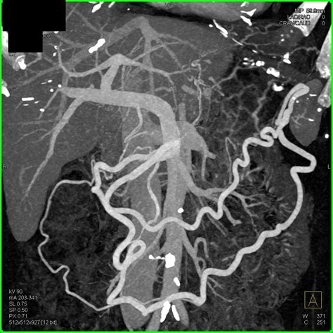 Adenocarcinoma Pancreas - Pancreas Radiology Case Studies - CTisus CT ...