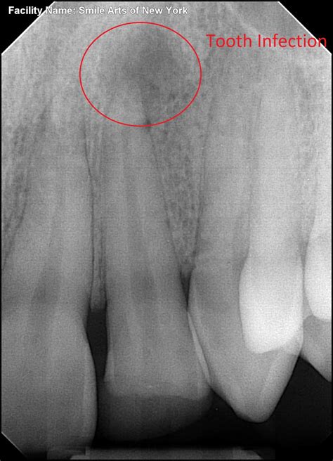 Root Canal Before And After Image Gallery | Root Canal NYC