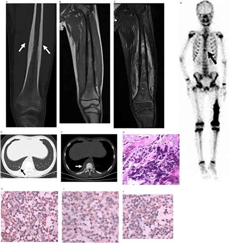 Ewing Sarcoma Vs Osteosarcoma