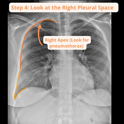 How to Read a Chest X-ray – Radiology for Newbs