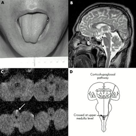 Medial Medullary Syndrome Mri