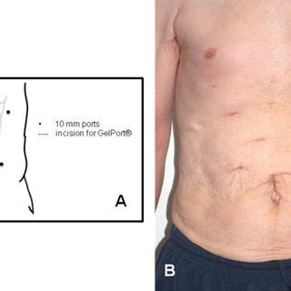 Image result for Hal Nephrectomy