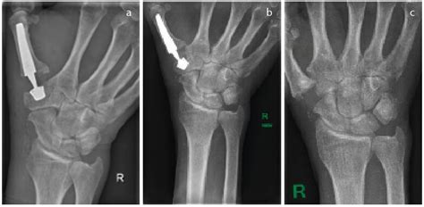 Die Bedeutung der richtigen Indikationsstellung - Orthopädie ...