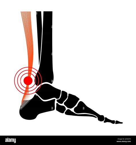 Achilles tendon injury, illustration Stock Photo - Alamy