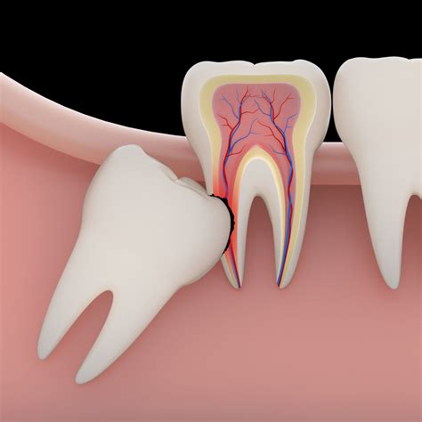 Impacted Wisdom Tooth Removal - Bolingbrook, IL - Extraction