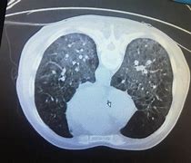 肺气肿 的图像结果