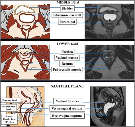 Vaginal cancer: Why should we care? Anatomy, staging and in-depth imaging-based review of ...