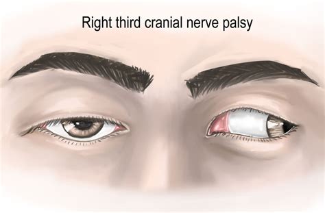 Sixth Nerve Palsy
