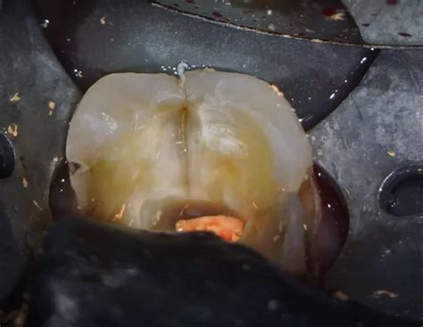 Image result for Surgically Remove Tooth