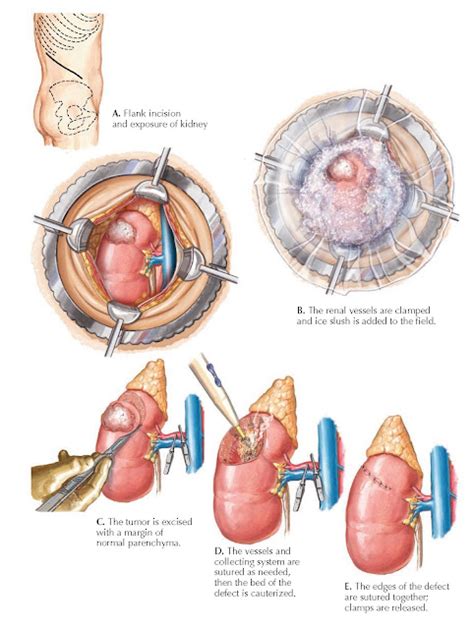 Image result for Steps of Partial Nephrectomy