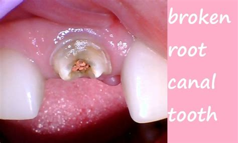 Image result for Root Extraction Tooth Broken Off