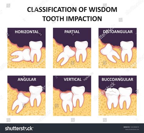 Image result for Wisdom Teeth Impaction Types