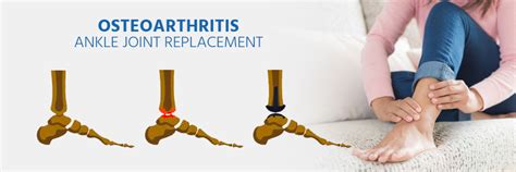 Ankle Replacement Surgery Cost in India - View Cost