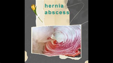 Exploding Cow Abscess 的图像结果