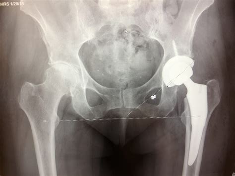 What Is A Partial Hip Replacement Surgery at Madeleine Darbyshire blog