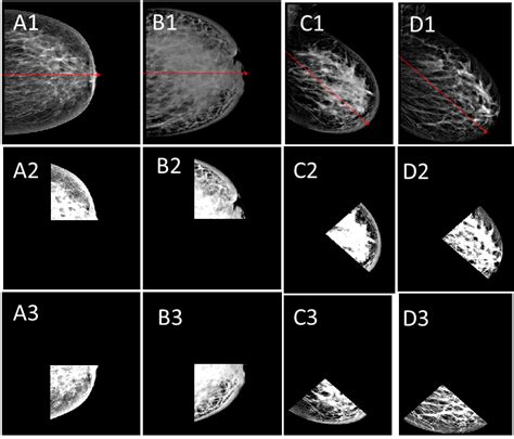 Imaging Modalities in Inflammatory Breast Cancer (IBC) Diagnosis: A Computer-Aided Diagnosis ...