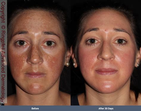Azelaic Acid Melasma