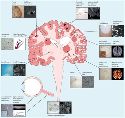 Multiple sclerosis progression: time for a new mechanism-driven framework - The Lancet Neurology