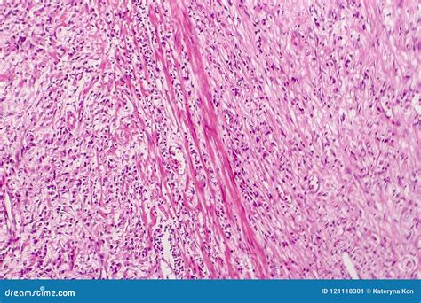 Signet ring cell carcinoma stock image. Image of microscope - 121118301