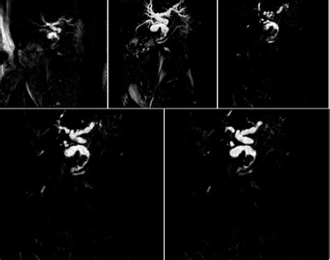 Image result for MRCP Biliary Tree