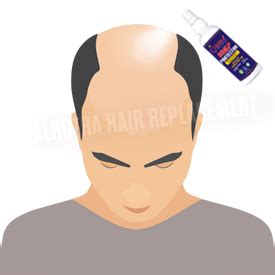 Natural Hair Patches for Men in Delhi | Trusted Hair Replacement Exper ...