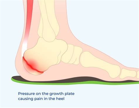 Treatment of Sever’s Disease - FitFeet Orthopaedic Solutions
