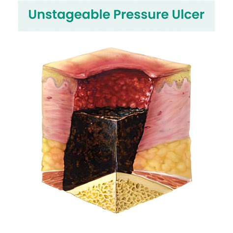 Identifying and treating unstageable pressure ulcers