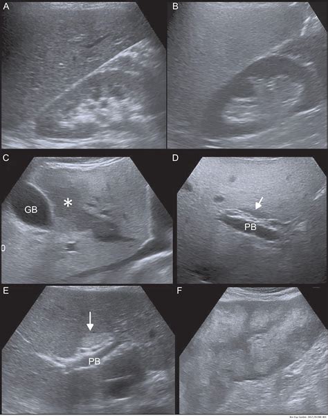 Normal Liver Ultrasound