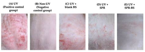 Novel Siprulina platensis Bilosomes for Combating UVB Induced Skin Damage