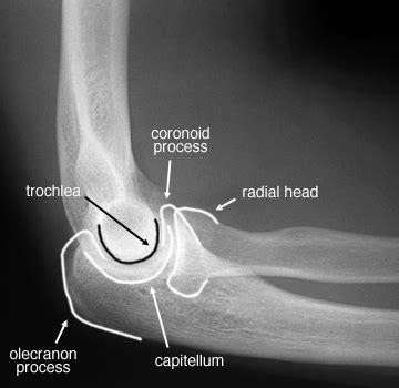 Image result for Elbow Contralateral
