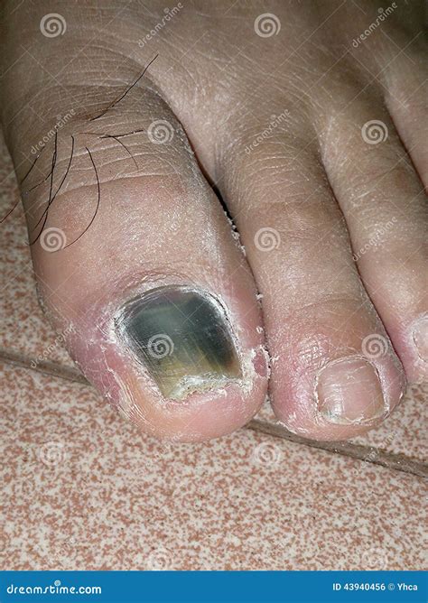 Toenail Turning Black