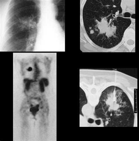Spiculated Lung Nodule Radiology at Joseph Cornwall blog