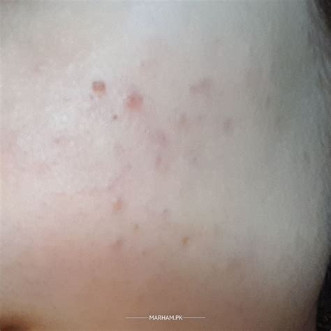 Ask a Dermatologist Online for Blackheads On Cheeks /Dry Skin