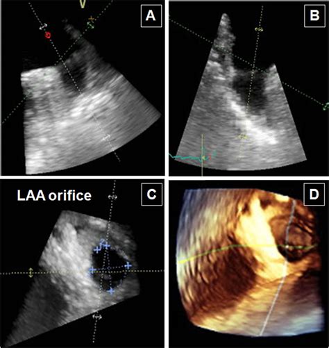 Left atrial appendage: anatomy and imaging landmarks pertinent to percutaneous transcatheter ...