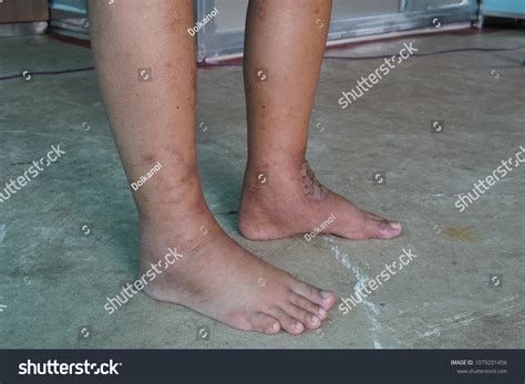 Renal Failure Edema