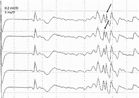 Image result for Single Fiber EMG Test